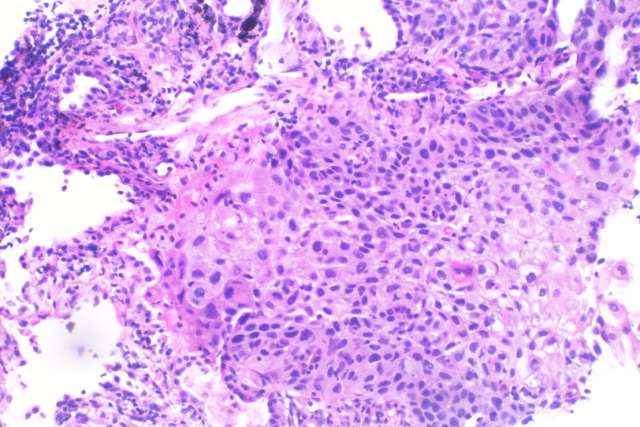 Histopathology of squamous cell carcinoma of the lung