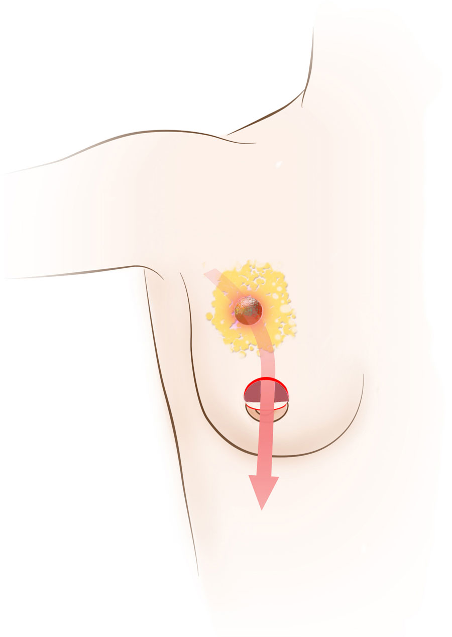 What is a Lumpectomy? - Breast Cancer  UCLA Health Jonsson Comprehensive  Cancer Center