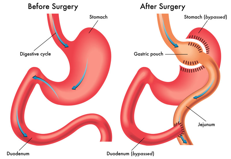 Gastric Bypass Surgery - Bariatric Surgery | UCLA Health