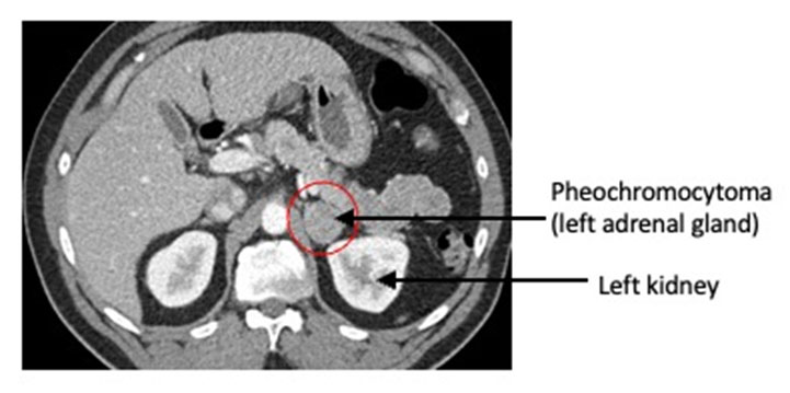 View of Surgical and Pharmacological Management of Functioning  Pheochromocytoma and Paraganglioma