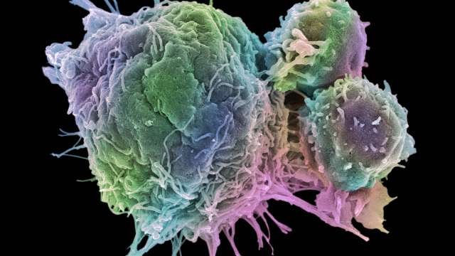 Cancer cell and T lymphocytes