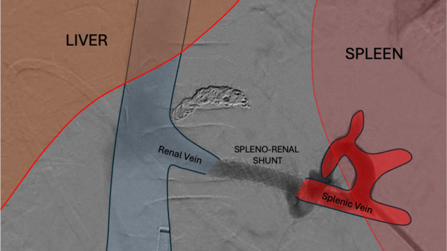 Illustration of a how a spleno_renal shunt works.