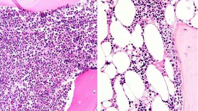 Bone marrow before and after chemotherapy images