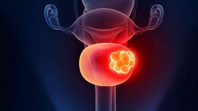 There are many levels of prostate/genitourinary cancers, and our UCLA team assures treatment is customized for each patient.