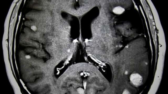 At UCLA, Radiation therapy is an important tool to relieve the symptoms associated with metastatic cancer.