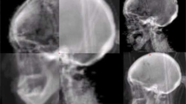 Brain & Spine Tumors