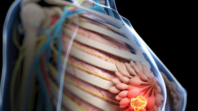 With over 30 years of experience, we have some of the most expertise on the use of HDR Brachytherapy for breast cancer in the nation.