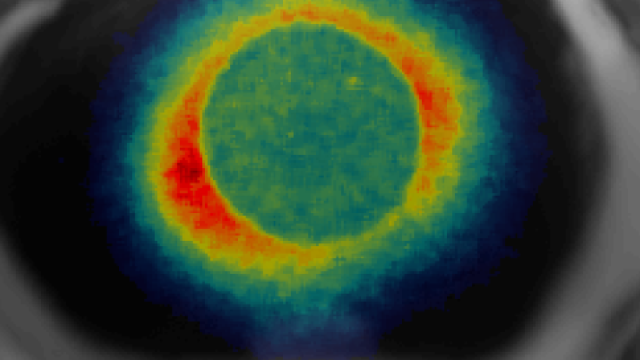 Close up of localized radiation (brachytherapy), a life-saving treatment that preserves the eyes.
