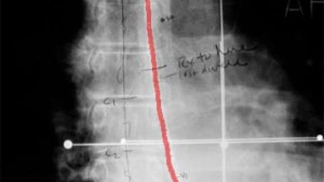 The treatment of esophagus and gall bladder cancers is similar in that they are both treated using "intralumenal" catheters.