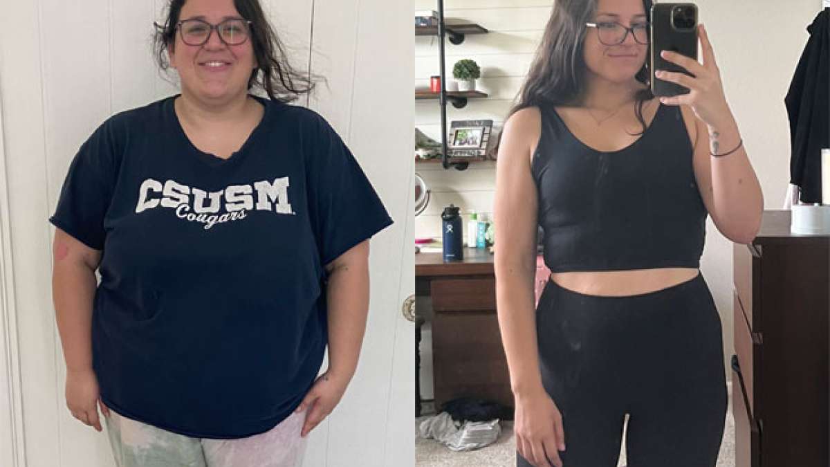 Gastric Bypass Before And After Pictures 2024