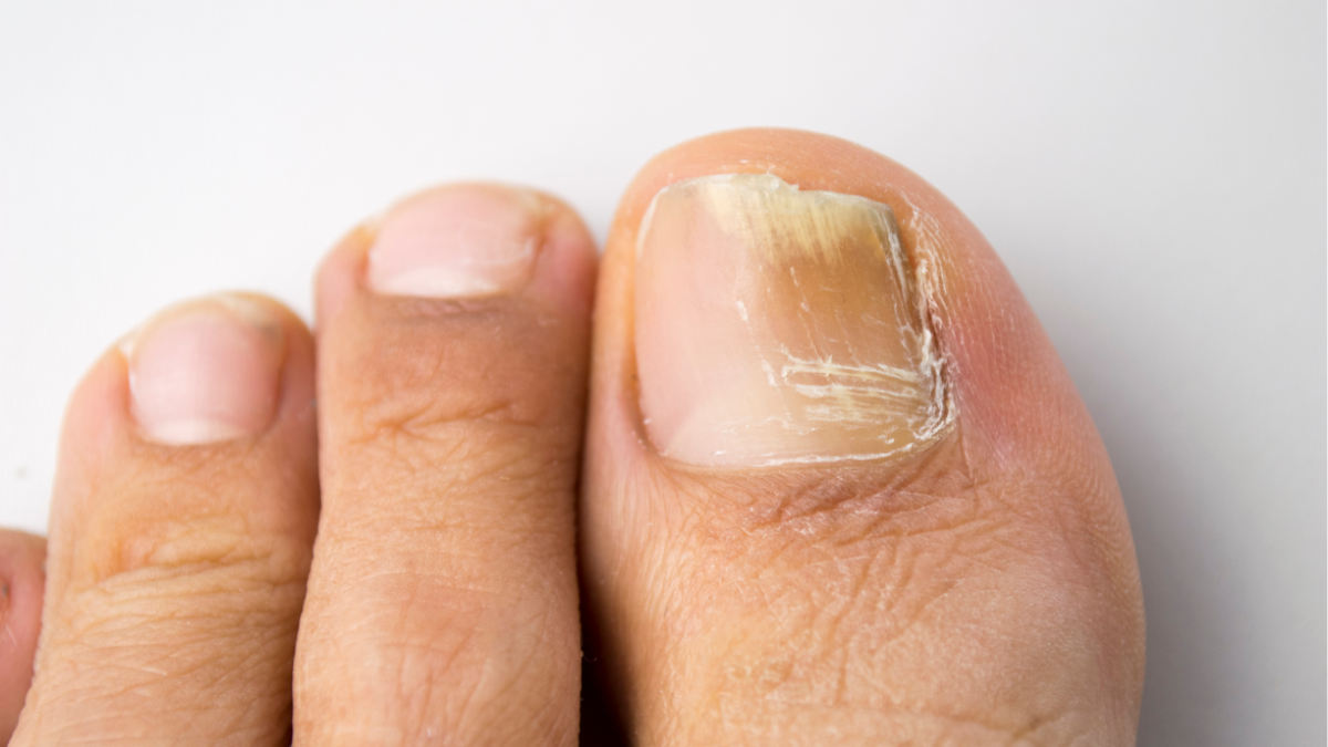 What Vitamins are Good for Nail Fungus 
