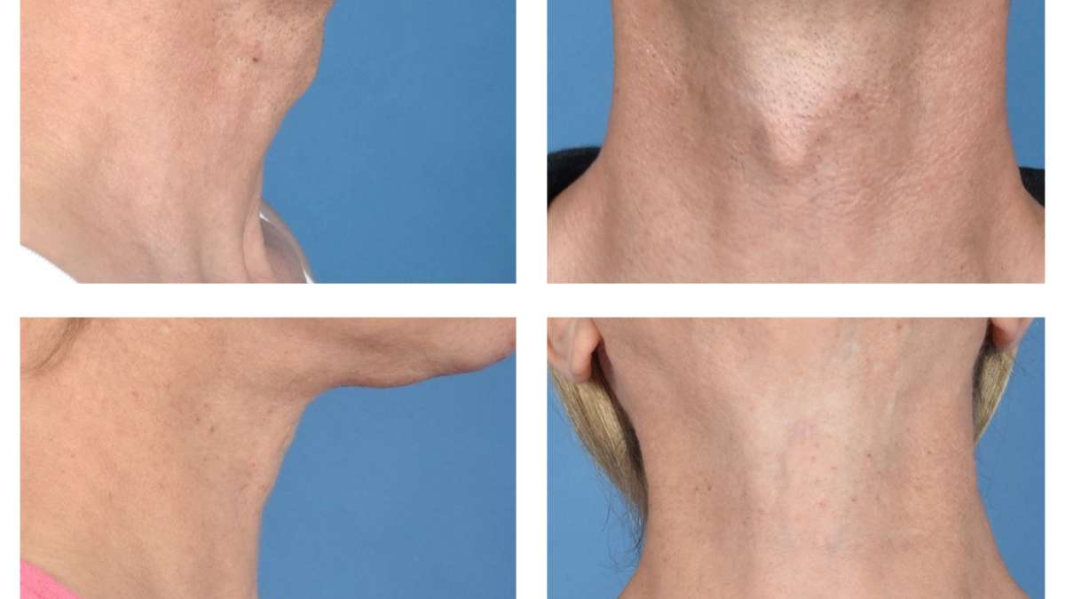 UCLA surgeons develop new technique to reduce Adam’s apple without neck scar