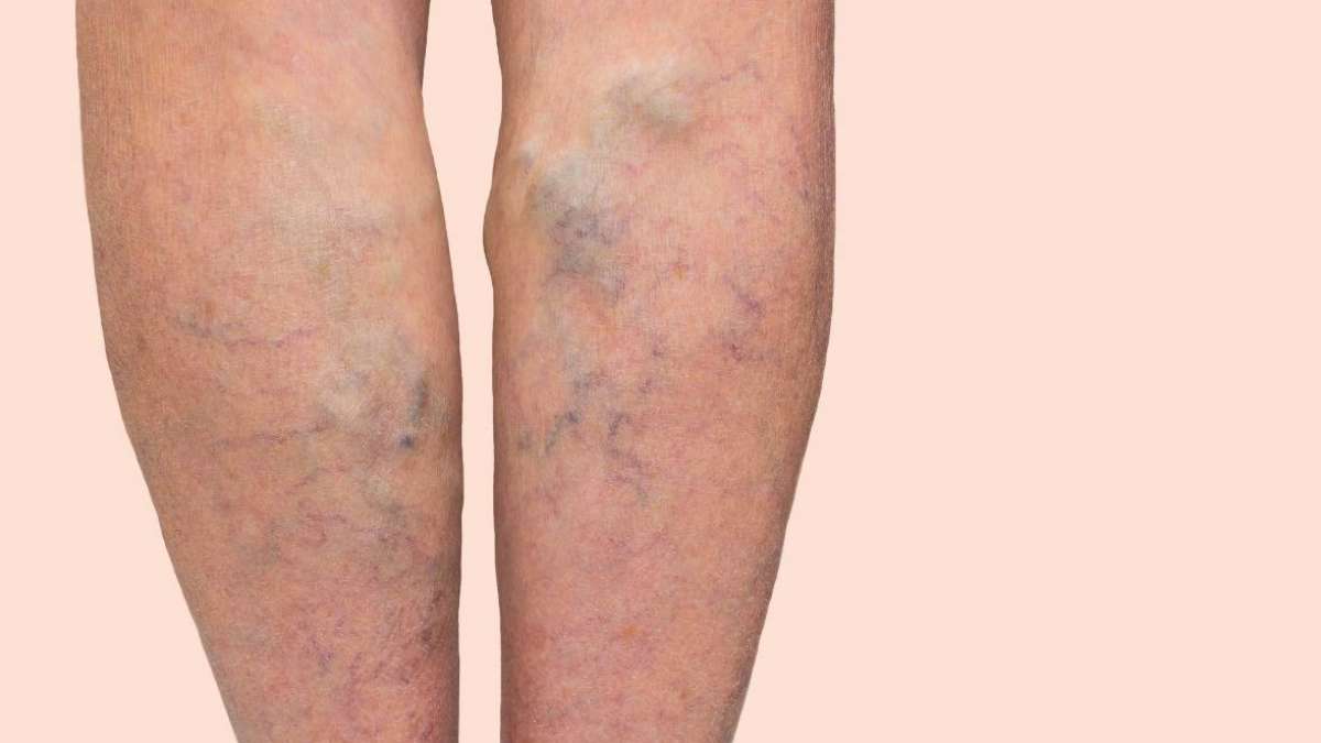 Link between DVT and varicose veins uncertain UCLA Health