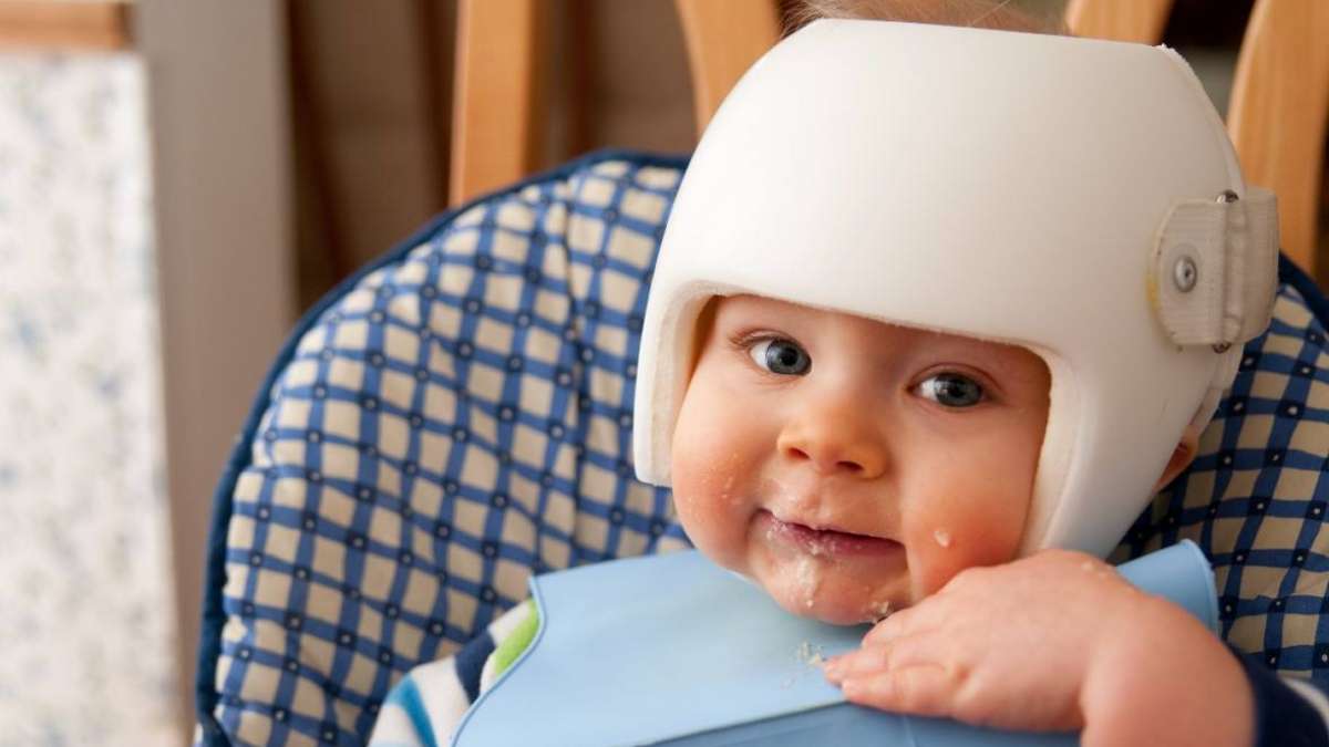 Does your baby need helmet therapy? 5 facts about flat head
