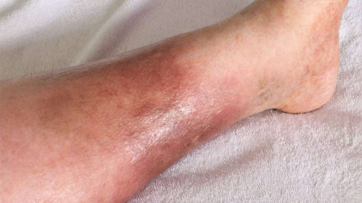 Hemosiderin staining product of trauma or venous insufficiency | UCLA Health