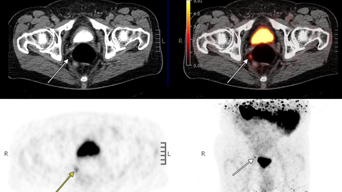 PSMA PET/CT Scans Improve Outcomes for Recurrent Prostate Cancer | UCLA Health - News Directory 3