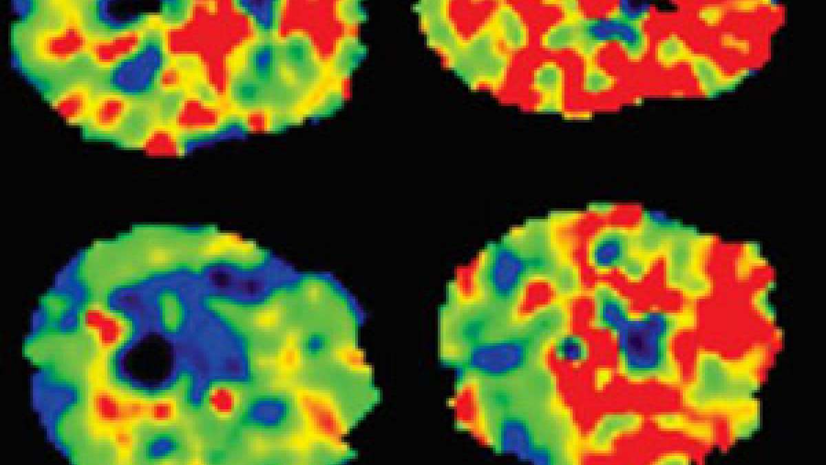 UCLA researchers provide first evidence of how obstructive sleep apnea