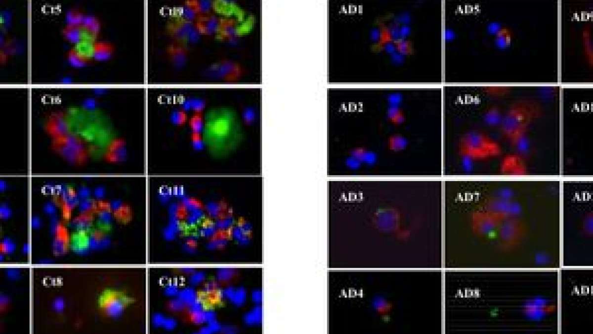 UCLA scientists identify how immune cells may help predict Alzheimer's ...
