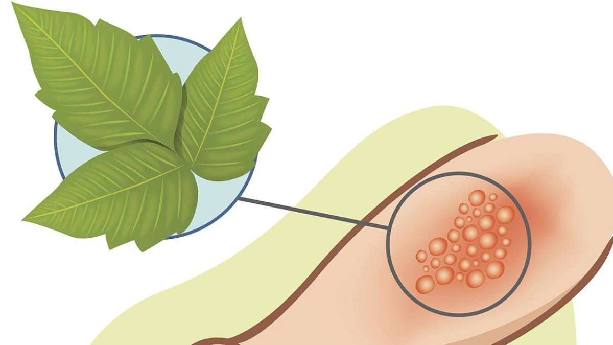 Poison Oak Rash Resolving What Is Best For Poison Oak Rash