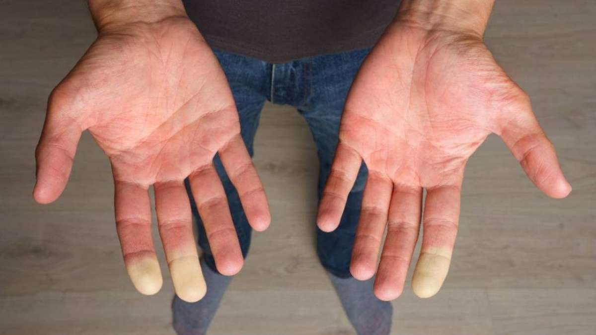Raynaud's phenomenon causes small arteries to contract UCLA Health