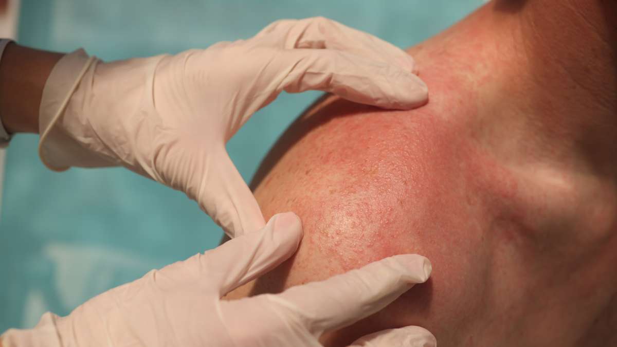 Red and itchy? When to worry about a rash in adults | UCLA Health