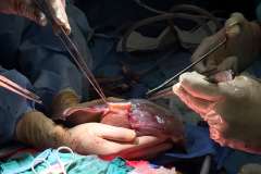 Liver Surgery Photo 1