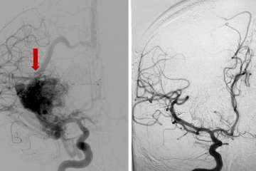 Anterior-Posterior view of a right frontal lobe AVM (red arrow) prior to surgery (left) and after embolization and surgical complete removal and cure (right).