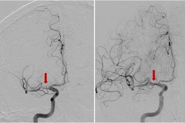Anterior-Posterior view of a cerebral angiogram demonstrating severe right middle cerebral artery stenosis (red arrow) due to acute clot formation on a brain vessel atherosclerotic plaque before treatment (left) and after treatment (right).