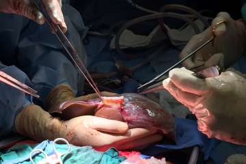 Liver Surgery Photo 1