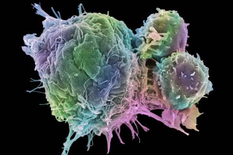 Cancer cell and T lymphocytes