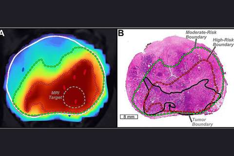 AI map of prostate tumor.