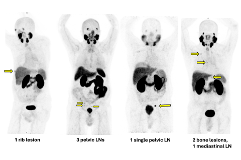 figure of PSMA PET scans 