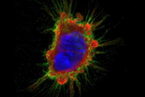 A bone cancer cell.