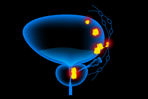 3D illustration of bladder cancer tumors