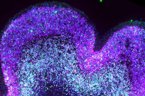 Developing neocortex in Down syndrome. IT neurons are labeled in magenta and deep-layer neurons in green. IT and double-positive neurons are increased in Down Syndrome at this stage.