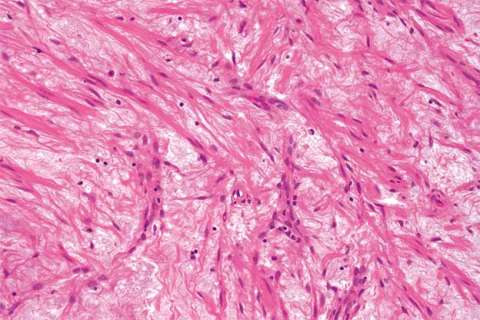 A Leiomyoma (fibroid) of the uterus.