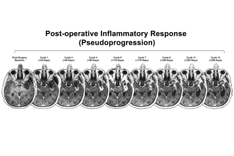 Post-operative Inflammatory Response (Pseudoprogression): axial MRIs showing evolving enhancement