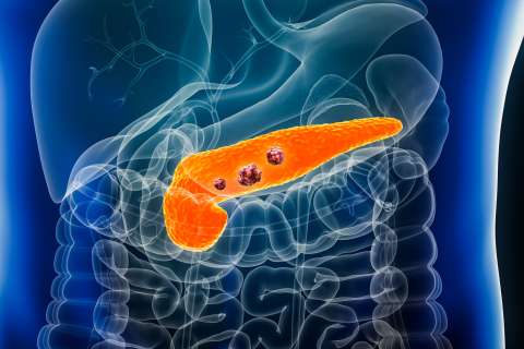 pancreatic cancer 