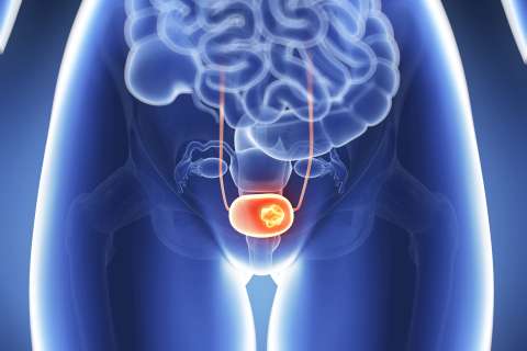3d rendered illustration - bladder cancer