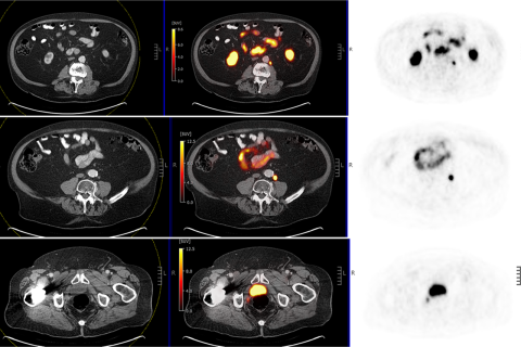 Axial PET/CT scans showing focal radiotracer uptake in abdomen and pelvis