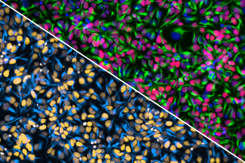 "Split fluorescence microscopy image of a neural progenitor cell village, divided diagonally. The top right shows cells with green cytoskeletal filaments and nuclei stained in pink, purple, and blue. The bottom left shows the same field with nuclei highlighted in orange, gray, and white against blue-stained cell bodies