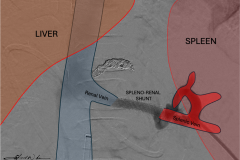 Illustration of a how a spleno_renal shunt works.