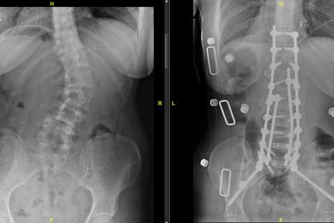 spinal xray