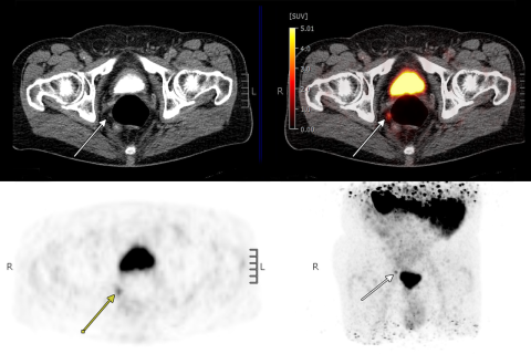 PSMA PT/CT scan