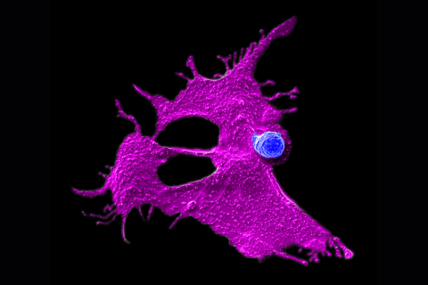 Microscopy image showing a stem cell-engineered CAR-NKT cell (blue) attacking a human solid tumor cell (magenta) against a black background