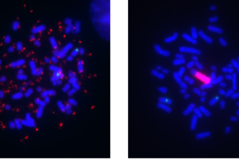 Melanoma cell lines showing gene amplification.Melanoma cell lines can harbor BRAF gene amplification (red signal) in two remarkably different modes, as extrachromosomal DNA (ecDNA) (left) and as an intrachromosomal homogeneously staining region (HSR) (right).