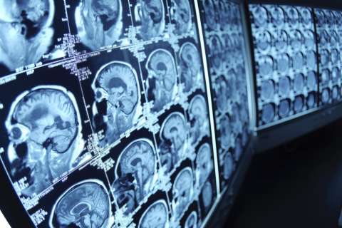 Images of an adult brain scan with epilepsy