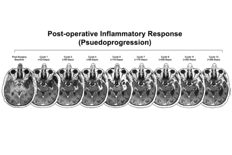 Axial brain scans showing evolving post-operative inflammatory response (pseudoprogression)