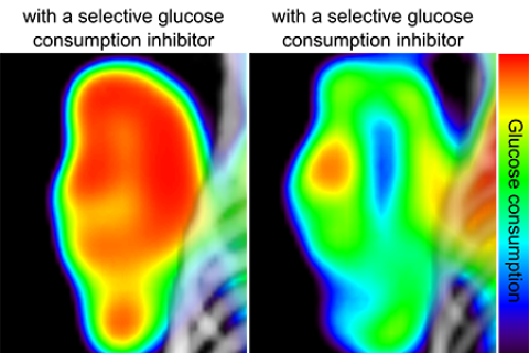 Cancer metabolism glucose consumption captured by heat scan.