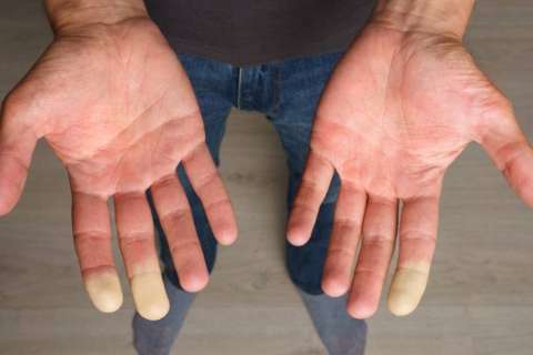 Raynaud's phenomenon